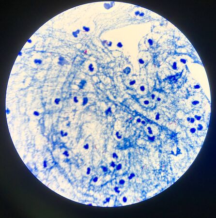 Red cells Mycobacterium tuberculosis in Sputum  positive 3 .
