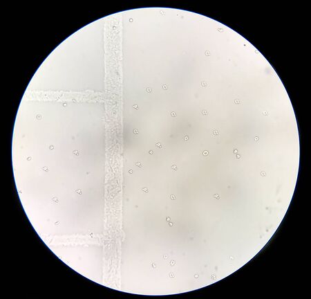 Moderate Dysmorphic red blood cells in urine sediment.