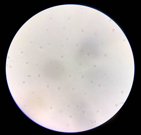 Moderate Dysmorphic red blood cells in urine sediment.の写真素材