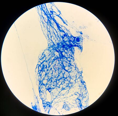 Positive acid fast bacilli red cells on blue background.Mycobacterium tuberculosis.