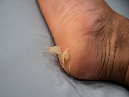 Close up foot of xerosis damage skin.の写真素材