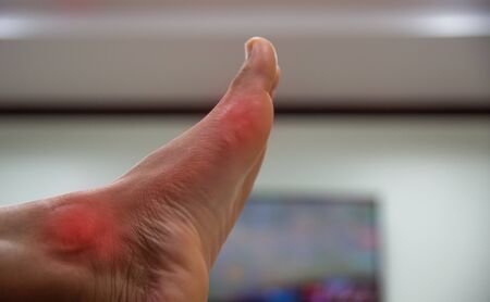Close up Foot of gout patient on blur background.