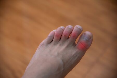 Close up Foot of gout patient on blur background.