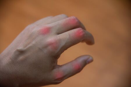 Close up hand of gout patient on blur background.