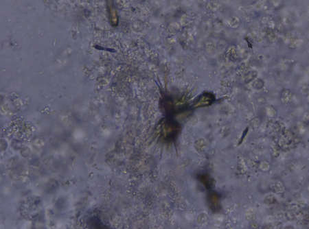 Sediment sulfonamide crystal in urine.Urinalysis concept.