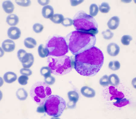 Immature cells in myeloid serie myelocyte metamyelocyte.