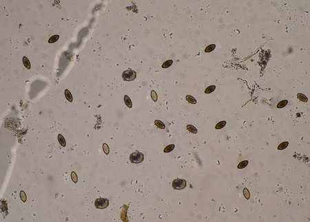 Mixed Ascaris lumbricoides and Trichulis trichiura egg in stool exam.の写真素材