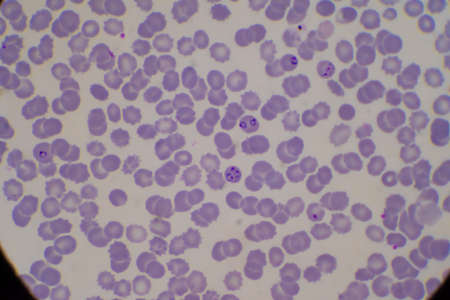 Blood parasite infected red blood cells Ring form Malaria.の写真素材