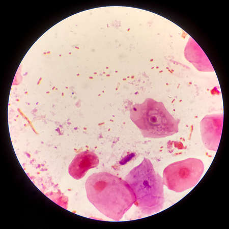 Red cells Bacteria cell Gram neagative bacilli with capsule pathogen.Sample sputum in Gram stain...