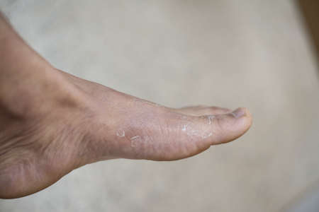 Cloxe up Foot of pateint skin dermatitis.