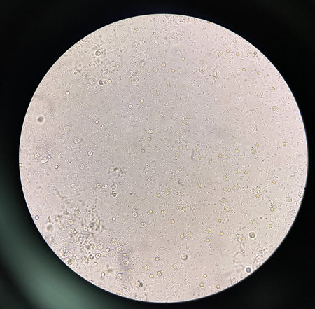 Moderate bacteria in urine sample UTI.の写真素材