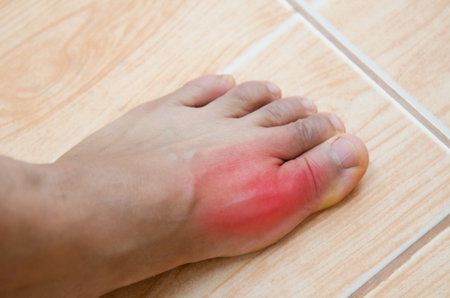Gout inflammatory arthritis that is very painful.の写真素材