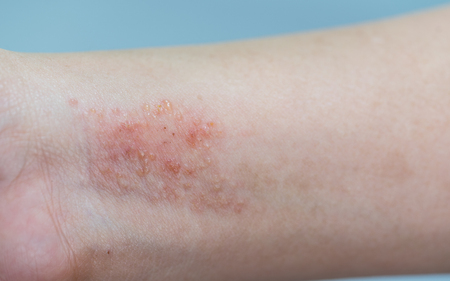 atopic dermatitis symptom skin on hand