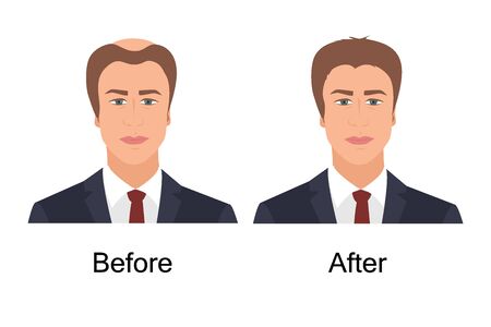 Man with alopecia before and after hair treatment and transplantation. Male baldness problem solution. Health and beauty concept for diagnostic centers and clinics. Vector illustration.のイラスト素材