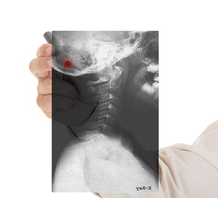 Doctor's hand with x-ray image of scull