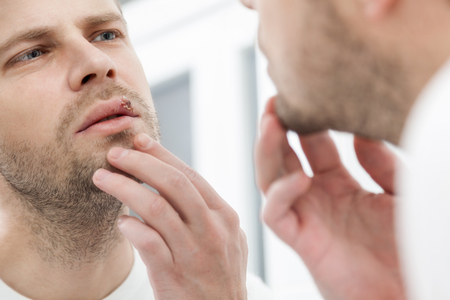 Young man suffering from painful herpes on his mouthの写真素材