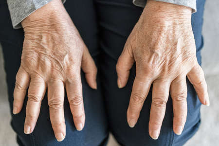 Senior woman at home suffering from arthritisの写真素材