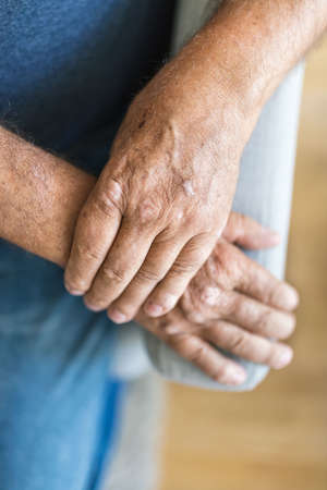 Elderly man suffering from psoriasis, closeup on handsの写真素材