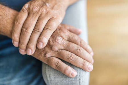 Elderly man suffering from psoriasis, closeup on handsの写真素材
