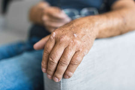 Elderly man suffering from psoriasis, closeup on handsの写真素材