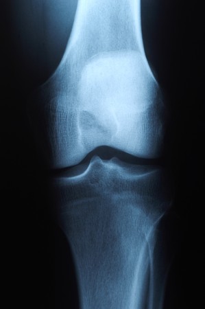 X ray photo of human kneeの写真素材