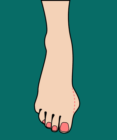 Hallux valguのイラスト素材