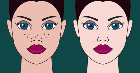 Whitening of face. Elimination of freckles and age spots. Girl before and after treatment. Vector illustrationのイラスト素材