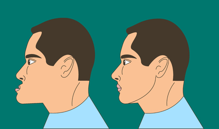 Mesial bite, man with malocclusion, lower jaw extended forward, bite correction by braces. Vector illustrationのイラスト素材