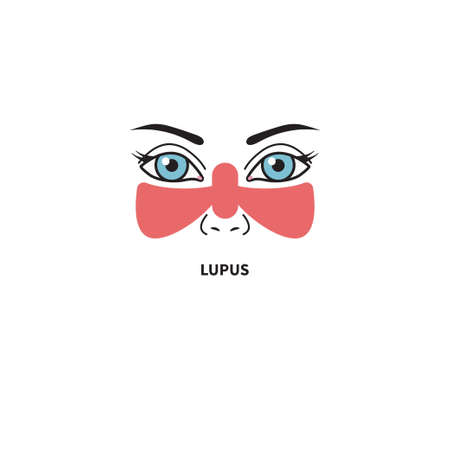 Systemic lupus erythematosus. Woman with red spot on her faceのイラスト素材