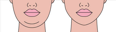 Double chin, restoration of facial contours with aid liposuctionのイラスト素材