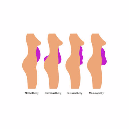 Different types and causes of abdominal obesity in womenのイラスト素材