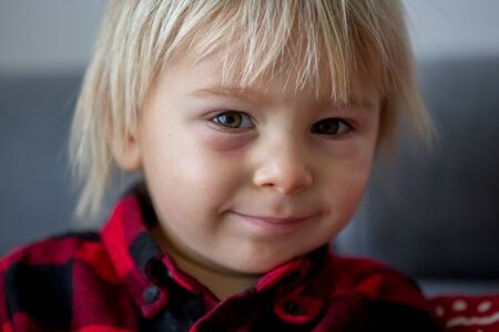 Blonde toddler boy with red burned spot under the eye, feeling pain, sad child