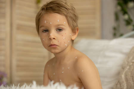 Toddler boy with chicken pox, lying in bed with fever, mother checking him with worry
