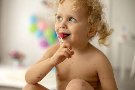 Little toddler girl with chickenpox in bed, playing at home, quarantine isolation during sickness,...