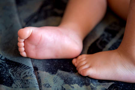 Children feet, sting by a bee, summertimeの写真素材