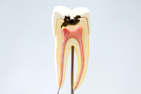 Decayed tooth model with white backgroundの写真素材
