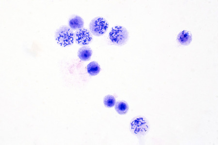 Human chromosomes from blood under microscope view for education.