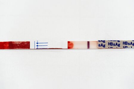 Hepatitis B Surface Antigen (HBsAg) Test Strip is a rapid, qualitative test for the detection of hepatitis B surface antigen in whole blood, serum and plasma, to aid in the diagnosis of hepatitis B viral infection.の写真素材