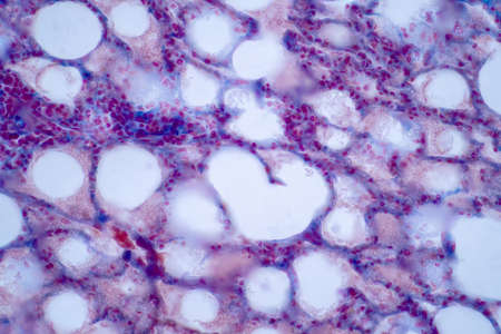 Human lung pathology under light microscope, The lungs is organs of the respiratory system in humans. Human pathology education. Haematoxylin and eosin staining technique slide.の写真素材
