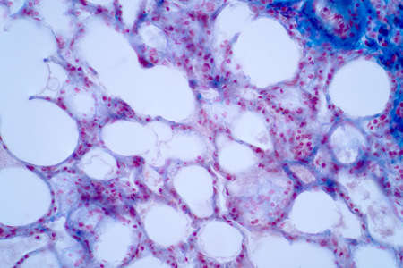 Human lung pathology under light microscope, The lungs is organs of the respiratory system in humans. Human pathology education. Haematoxylin and eosin staining technique slide.の写真素材