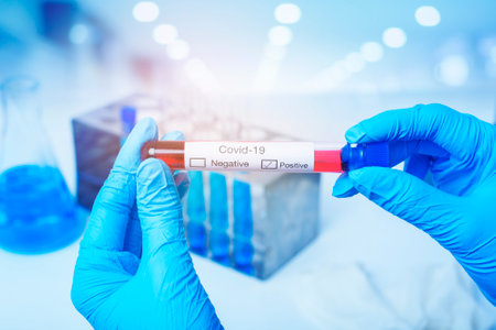laboratory assistant hand is holding blood test infected Covid-19の写真素材