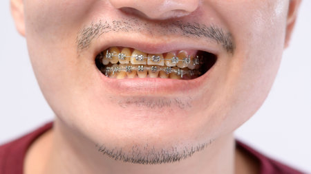 Close up of Man's mouth with braces , yellow plaque teeth  because drinking coffee regularly
