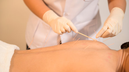 Beautiful Woman Received acupuncture treatment on back by  therapist, chinese medicine treatment, health and healing concept.の写真素材