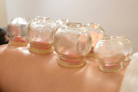 Beautiful Woman Received cupping treatment on back by  therapist, chinese medicine treatment, health...