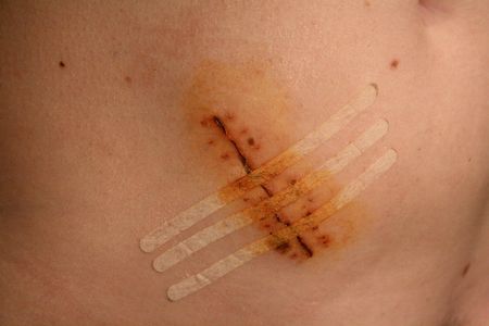 View of the stitches on a cicatrice of a female belly after an appendicitis operation.の写真素材