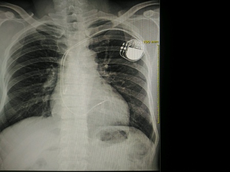 Cardiac pacemaker in body X-ray Chestの素材