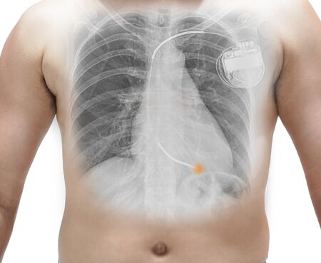 Close up Human chest and x-ray. showing pacemaker.