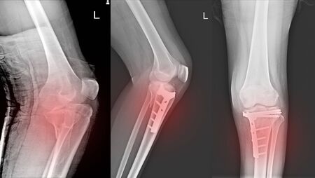 X-ray Knee Joint Fracture proximal tibia and Post fix fracture proximal tibia with plate and screws. Normal joint space. Minimal joint effusion.の写真素材