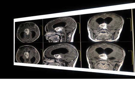 MRI Brain and orbits a boy 10 year old. showing a3.5cm. suprasellar mass cause mass effect to optic chiasm,pituitary gland, third ventricle, hypothalamus.Image too blurry and dark.の写真素材