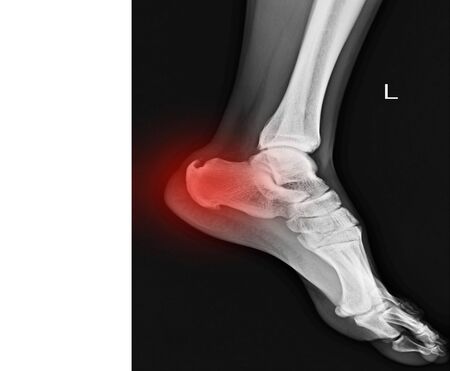 X-ray left foot showing Calcaneal spur on red color with copy space.の写真素材
